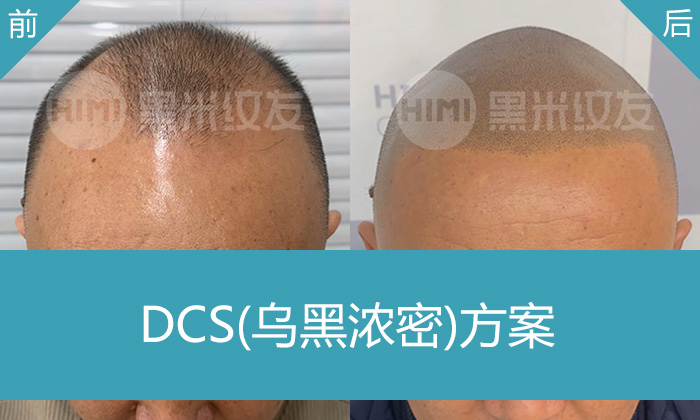 脱发8年从M角到后脑勺怎么办？武汉黑米纹发让尤先生重获寸头自信