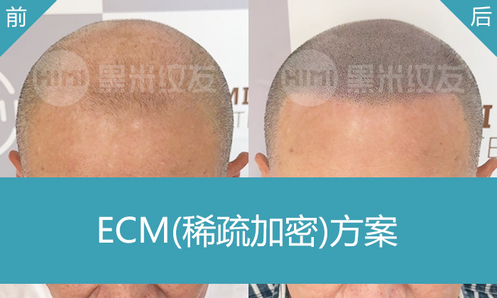 广州黑米纹发案例｜葛先生地中海秃顶逆袭，无法生发也能拥有浓密寸头