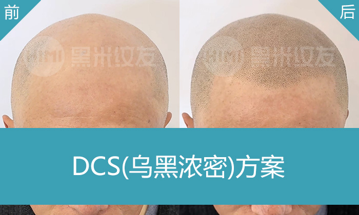 严重秃头20年，后脑勺没头发还有救吗？重庆郑先生纹发真实案例