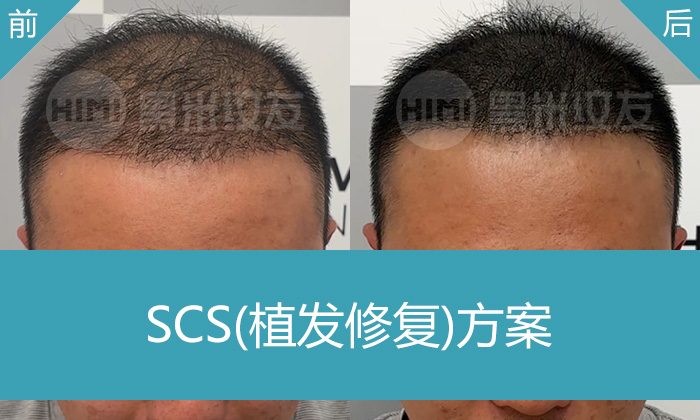 植发失败后还能补救吗？杨先生5年脱发发际线后移头顶稀疏纹发成功案例