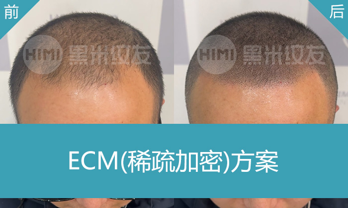 武汉纹发案例_翁先生头顶稀疏M角后移5年_米诺地尔无效纹发后年轻5岁