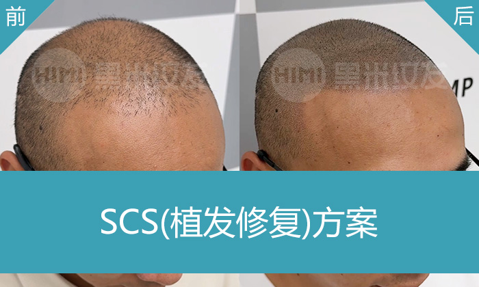 广州黑米纹发：陈先生8年脱发终解决，重塑浓密发量，告别植发疤痕