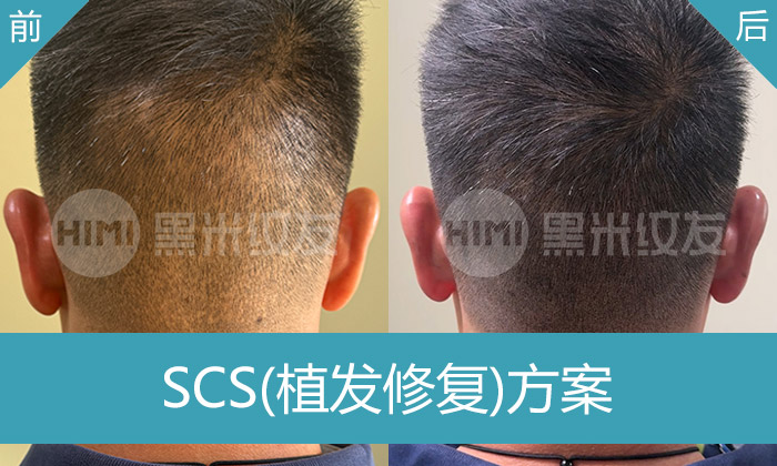 植发后疤痕修复案例:李先生5年脱发,植发后疤痕在黑米纹发修复遮盖