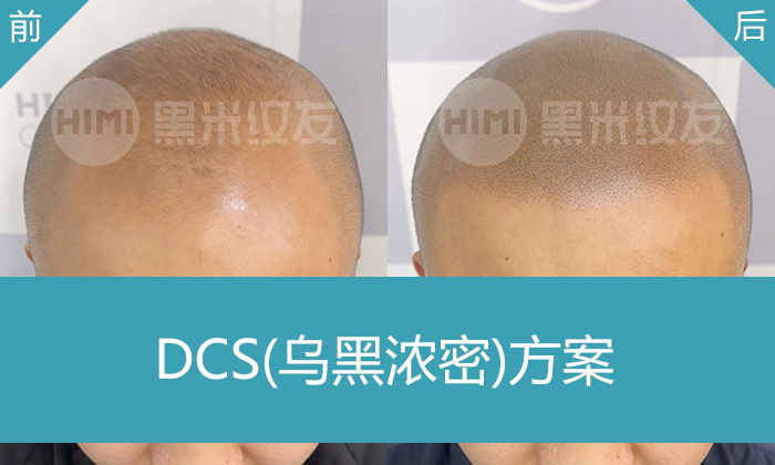 黑米纹发：秃顶纹发前后效果对比