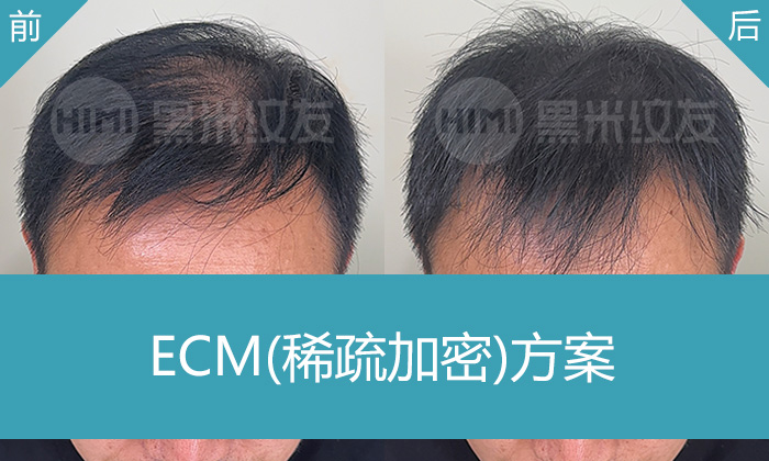 广州黑米纹发案例｜赵先生10年头顶稀疏逆袭，告别露头皮尴尬