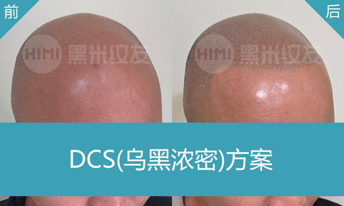 脱发8年头顶全秃，米诺地尔无效！王先生在广州黑米纹发后逆袭寸头型男