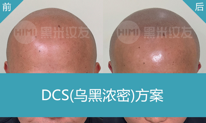 广州黑米纹发_秃顶10年范先生蜕变，米诺无效后重拾浓密寸头