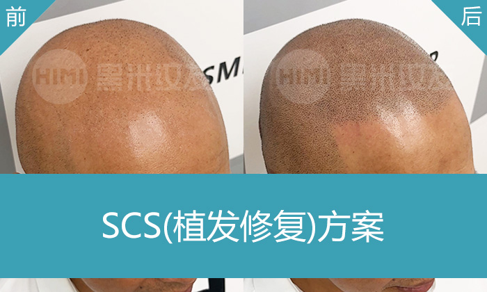 植发失败怎么办？龙先生在重庆黑米纹发效果：疤痕遮住了，头发浓密了