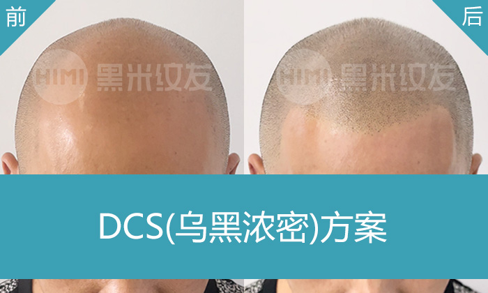 王先生8年脱发困扰：头顶秃顶、头发稀疏，在杭州黑米纹发后重获浓密寸头