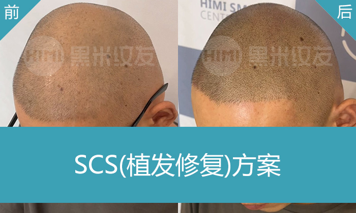 植发失败后怎么办？杨先生8年脱发史：从地中海秃顶到纹发重获浓密寸头