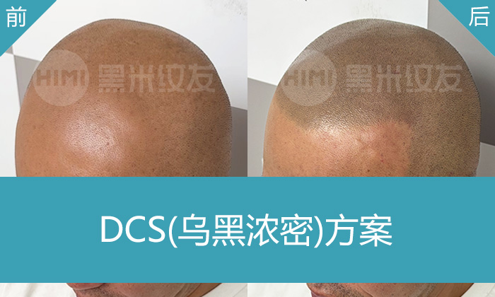 姜先生10年脱发秃顶逆袭：武汉黑米纹发后年轻5岁，重拾自信