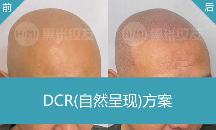 沈阳黑米纹发真实体验：冯先生秃顶10多年，纹发后年轻5岁