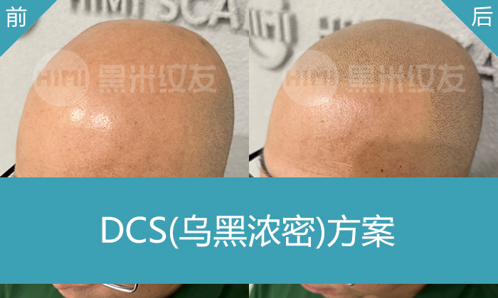 长春黑米纹发真实体验：包先生秃头变浓密寸头，摆脱多年脱发困扰