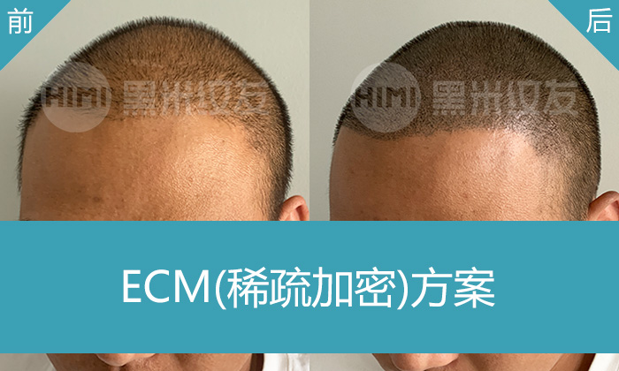 被脱发困扰5年，刘先生选择广州黑米纹发：头顶稀疏到浓密