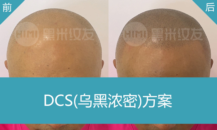 重庆黑米纹发真实经历：廖先生从秃顶到浓密寸头，终于不脱发了