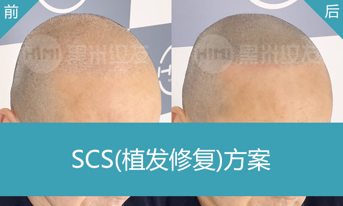 李先生纹发后后悔没早做！10年脱发、植发失败，终在杭州黑米纹发找回自信