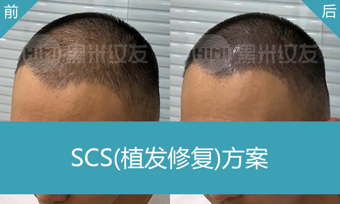 脱发5年植发失败怎么办？尚先生在武汉黑米纹发后的真实感想
