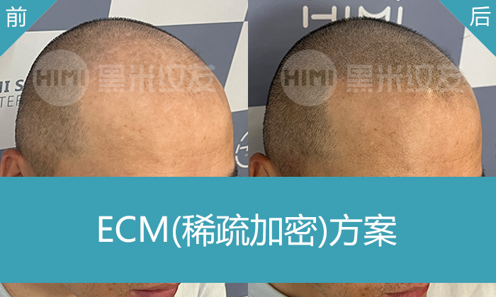 济南黑米纹发拯救脱发危机，仪先生5年发际线后移头顶稀疏变年轻寸头