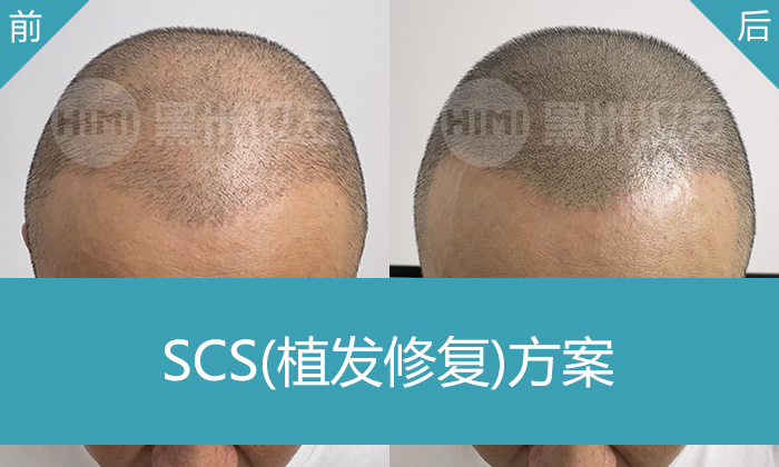 北京黑米纹发真实体验｜植发后头发稀疏，纹发帮石先生重拾自信