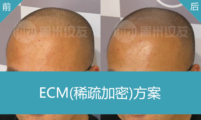 沈阳黑米纹发真实体验｜发际线后移头顶稀疏，纹发帮刘先生重获浓密发型