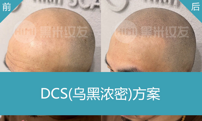 长春黑米纹发真实体验｜管先生秃顶变浓密寸头
