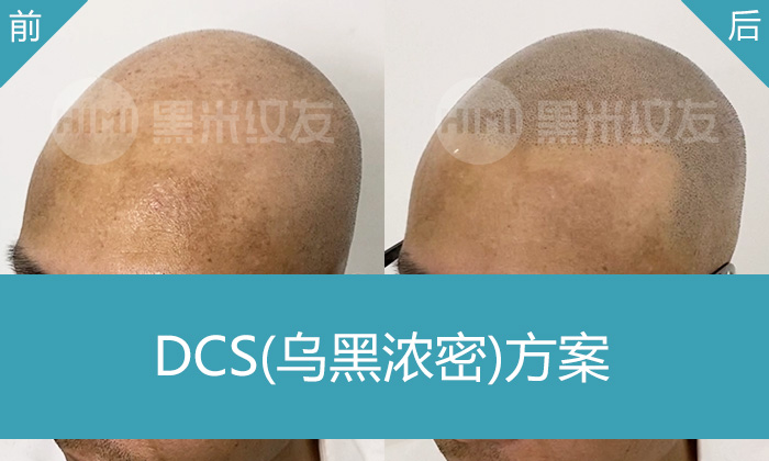 广州黑米纹发真实体验｜陈先生脱发秃头变浓密寸头