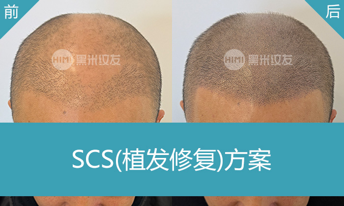 重庆黑米纹发真实体验｜罗先生植发失败秃顶变浓密寸头