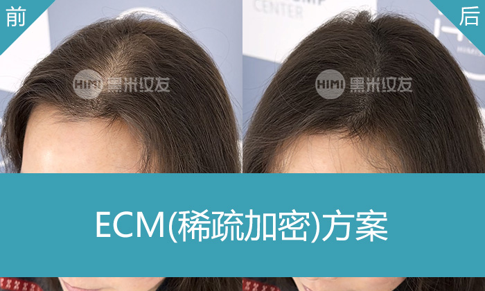 杭州黑米纹发真实体验｜汪女士发缝宽变浓密