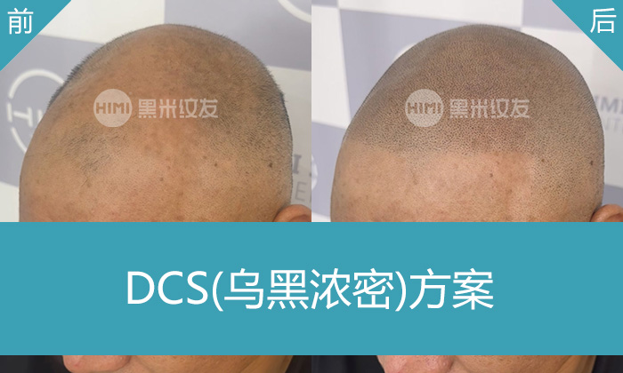 武汉黑米纹发真实体验｜叶先生脱发秃顶变浓密寸头