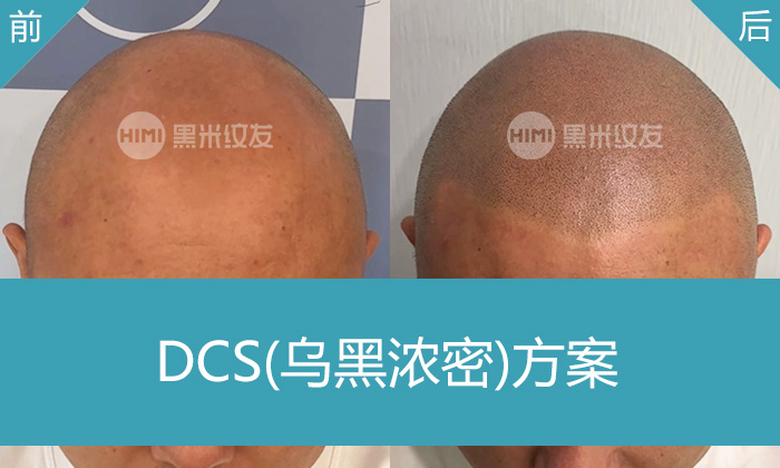 济南黑米纹发真实体验｜郑先生脱发秃头变浓密寸头