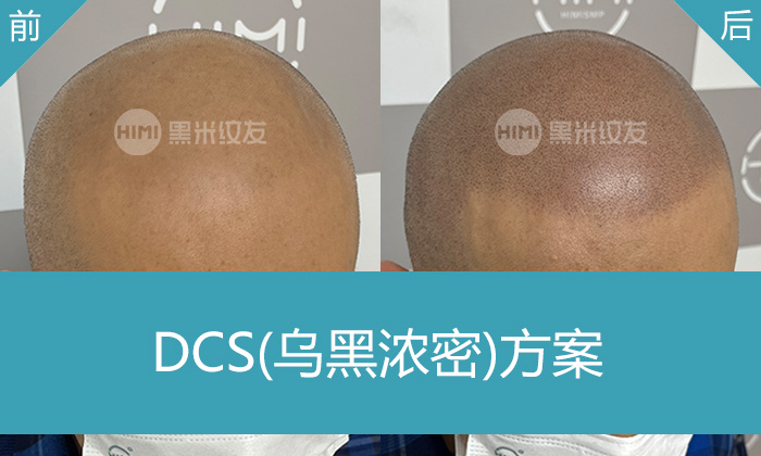 北京黑米纹发真实体验｜宁先生脱发秃顶变浓密寸头