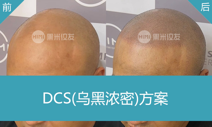 沈阳黑米纹发真实体验｜谢先生脱发秃顶变浓密寸头