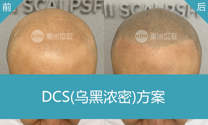 长春黑米纹发真实体验｜孙先生脱发秃顶变浓密寸头