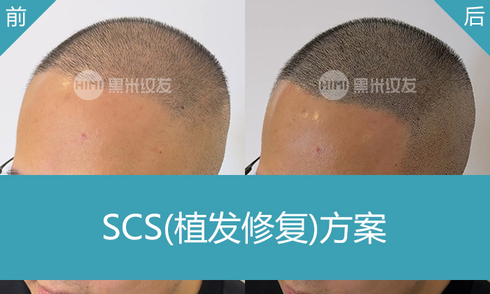 重庆黑米纹发真实体验｜林先生植发失败头顶稀疏变浓密