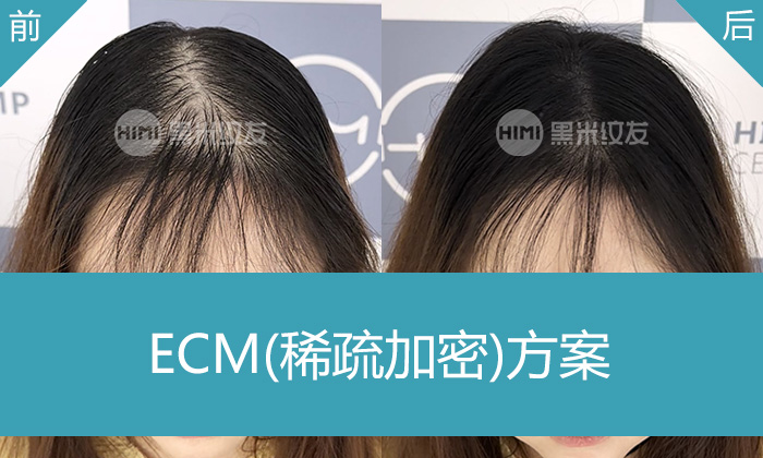 杭州黑米纹发真实体验｜刘女士宽发缝变窄变浓密