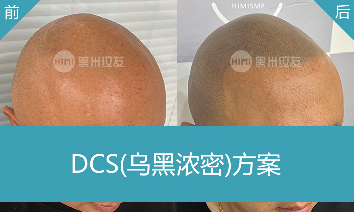 武汉黑米纹发真实体验｜沈先生脱发秃顶变浓密寸头显年轻