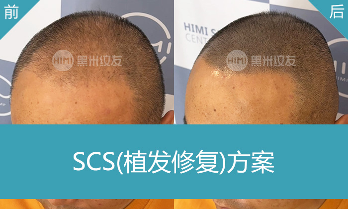 济南黑米纹发真实体验｜曹先生植发失败头顶稀疏变浓密