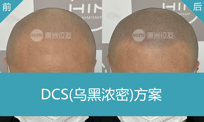 北京黑米纹发真实体验｜岳先生脱发秃顶变浓密寸头