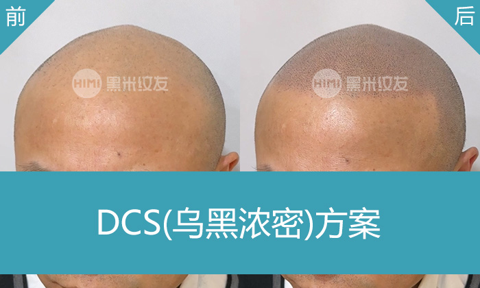 沈阳黑米纹发真实体验｜张先生秃顶10年重获浓密寸头