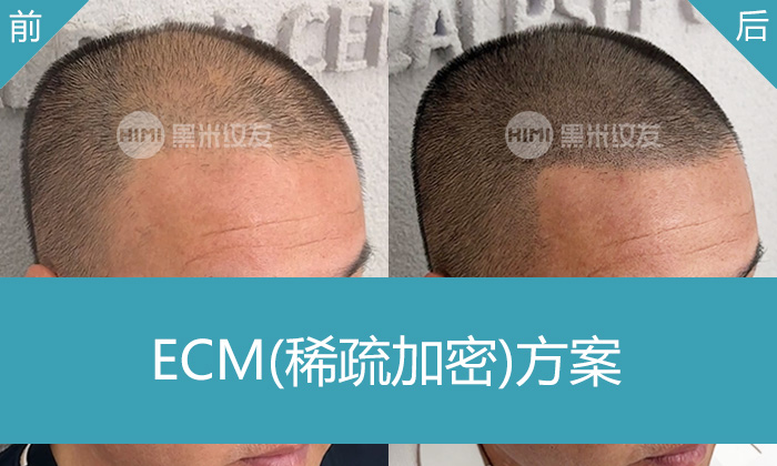 长春黑米纹发真实体验｜孟先生脱发10年头顶稀疏变浓密