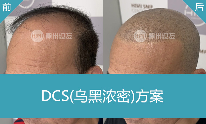 广州黑米纹发真实体验｜陈先生头顶稀疏20年变浓密寸头