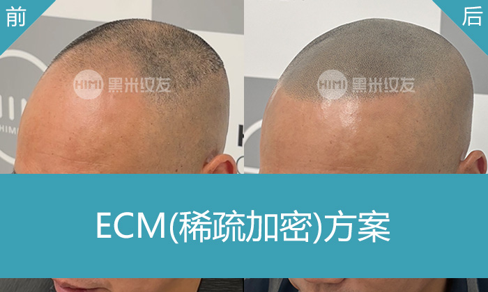 重庆黑米纹发真实体验｜刘先生发际线后移头顶稀疏变浓密盖头