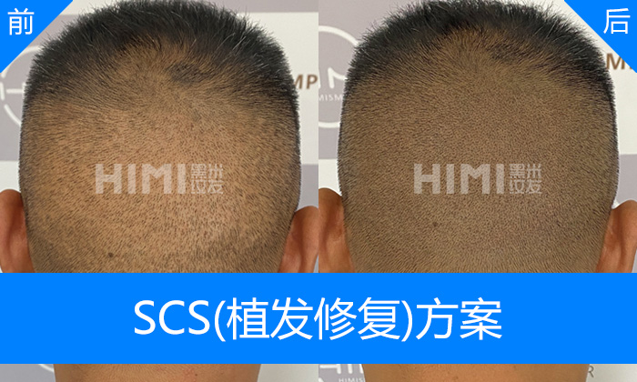 SCS植发修复