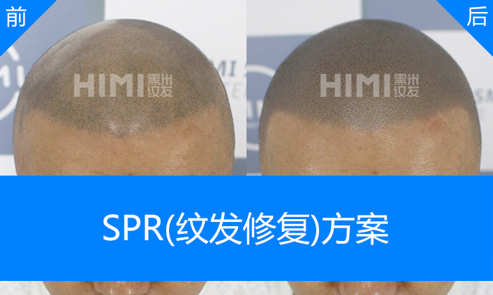 SPR纹发修复