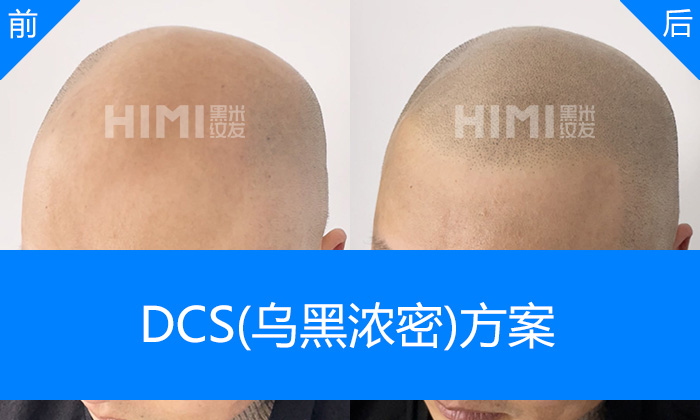杭州黑米纹发真实体验｜孙先生秃顶20年变浓密寸头