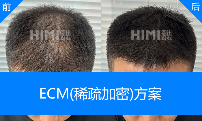 武汉黑米纹发真实体验|彭先生脱发5年头顶稀疏变浓密