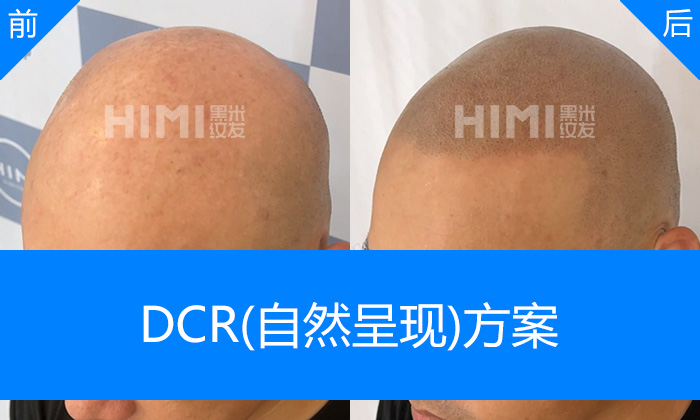 济南黑米纹发真实体验｜常先生秃顶20年变浓密寸头