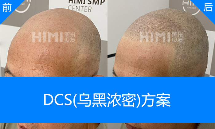 北京黑米纹发真实体验|胡先生脱发10+年秃顶修复