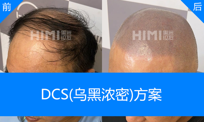 沈阳黑米纹发真实体验|刘先生脱发20+年秃顶修复