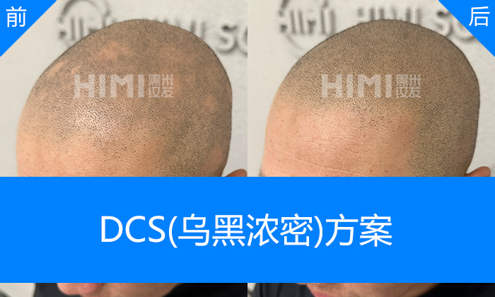 长春黑米纹发真实体验|武先生脱发5年斑秃遮盖